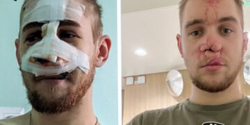 Постраждалий від січневого обстрілу запоріжець лікується в Австрії | Новини Запоріжжя