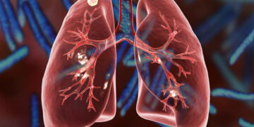 Як пацієнтам з туберкульозом отримати безоплатно медичну допомогу в Івано-Франківській області: роз’яснення НСЗУ