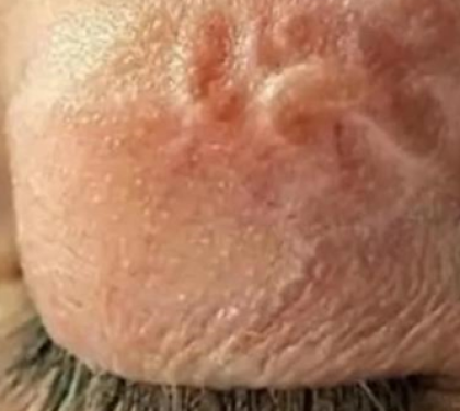 З ока львів’янина лікарі витягнули 11-сантиметрового гельмінта