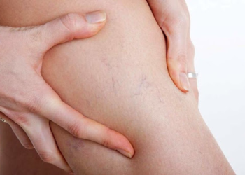 Як подолати варикоз: поради та перевірені методи лікування