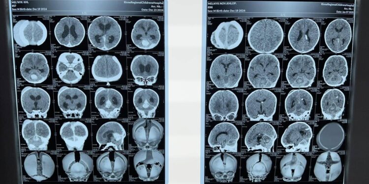 Рівненські лікарі подарували шанс на здорове життя новонародженому з рідкісною патологією