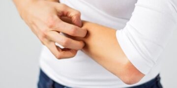 У Каневі зафіксували випадки захворювання корости