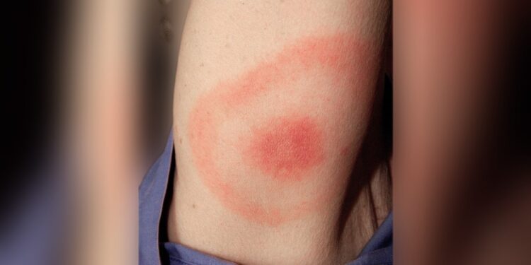 Полтавщина перебуває на другому місці за поширенням хвороби Лайма в країні