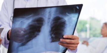 У Канівській громаді зростає захворюваність на пневмонію