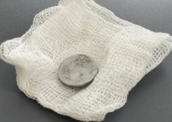 Три місяці з батарейкою у стравоході: у Львові врятували дворічну дівчинку